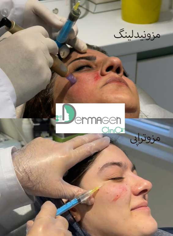 مزوتراپی یا مزونیدلینگ؟ بررسی کامل هر دو روش