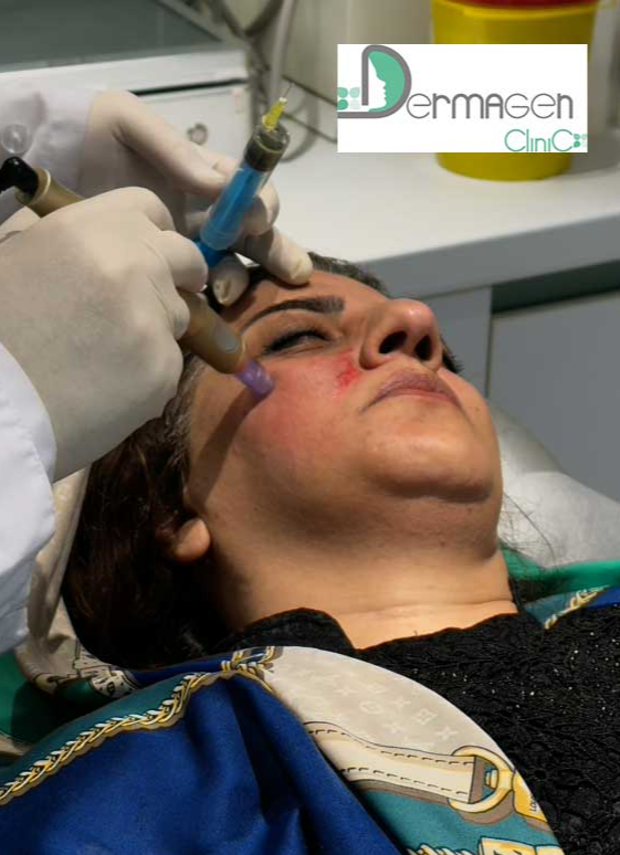 مزونیدلینگ برای جای جوش، روشی موثر برای بازسازی پوست و افزایش اعتمادبه‌نفس