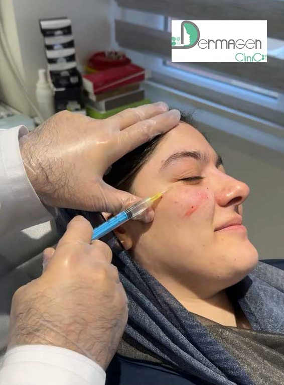 تفاوت میکرونیدلینگ و مزونیدلینگ، کدام روش برای پوست مناسب‌تر است؟