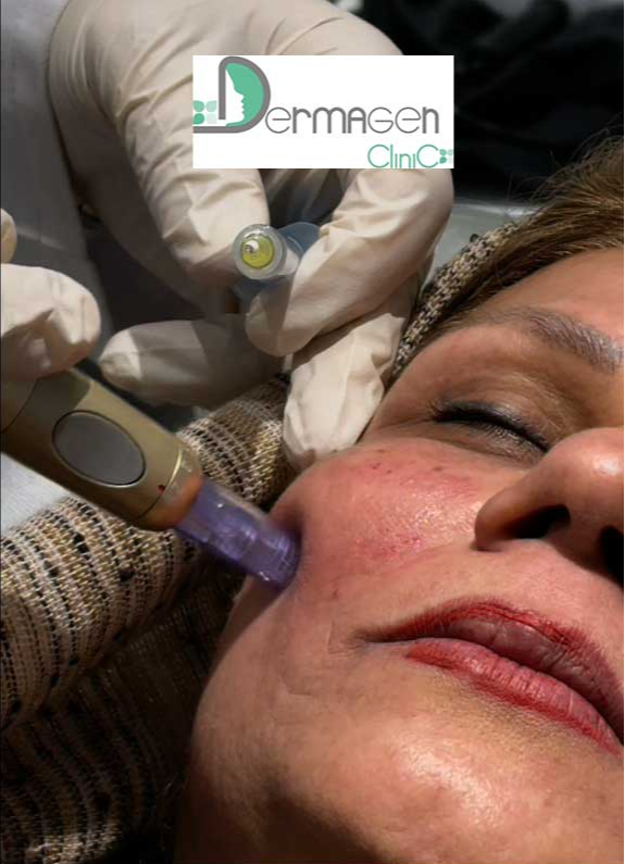 تیرگی پوست بعد از مزونیدلینگ، بررسی دلایل ایجاد آن و راهکاربرطرف کردن تیرگی