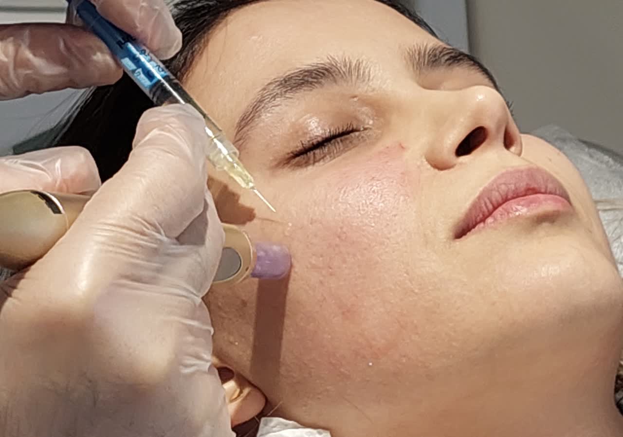مزونیدلینگ صورت